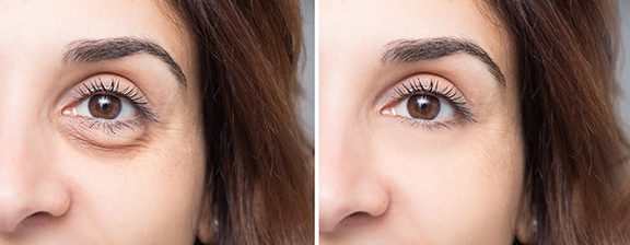 photo of a woman's face before and after blepharoplasty